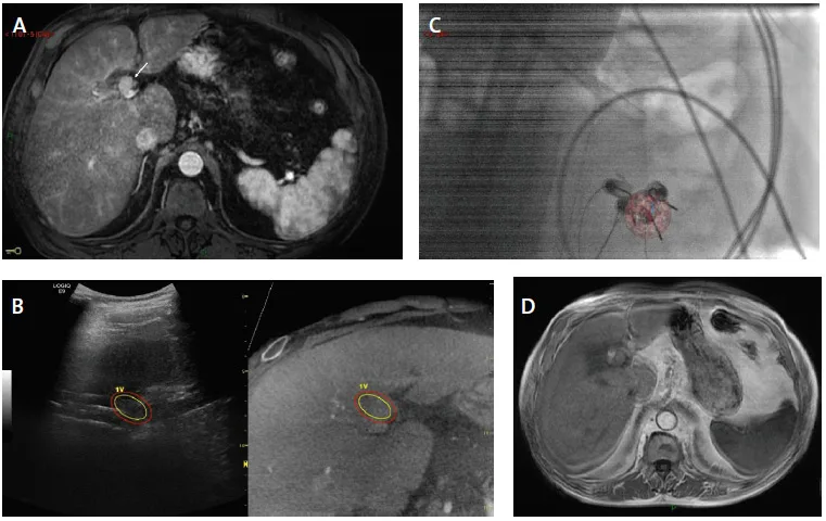 Figure 5. Ablation par electroporation irréversible par guidage multimodale fusionné d’un CHC nodulaire de 2 cm à développement préhilaire.