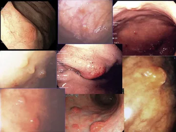 Figure 1. Photographies endoscopiques de tumeurs neuroendocrines de type 1 (Biermer).