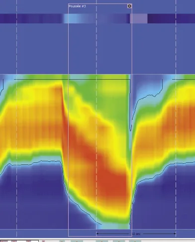 Figure 11. Lors de la poussée volontaire : descente de la zone de haute pression du sphincter anal compatible avec une descente périnéale