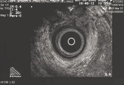 Figure 1. Coupe au niveau du muscle pubo-rectal