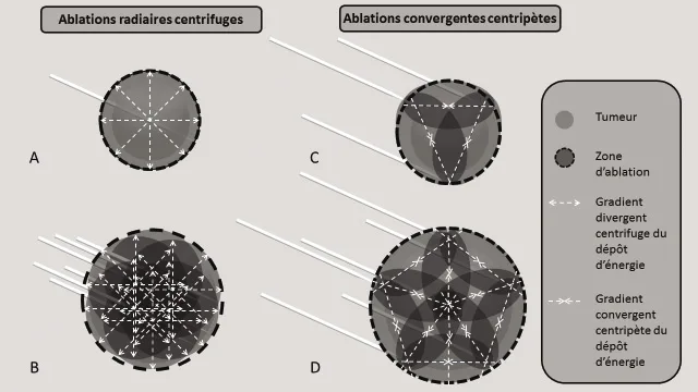 Figure 1. Stratégies de déposition in situ d’énergie pour l’ablation des tumeurs