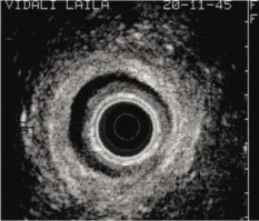 Figure 3. Défect isolé du SAI au niveau du quadrant postérieur gauche