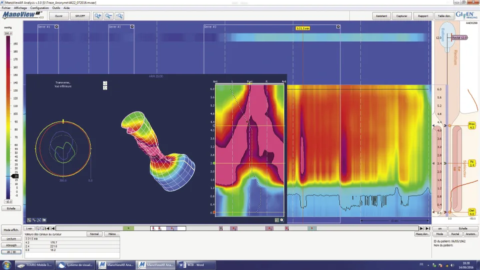 Figure 7. Exemple de tracé de MAR HD avec reconstitution en 3D et 2D
