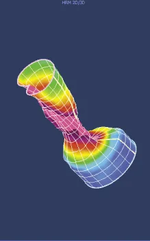 Figure 8a. reconstruction 3D du canal anal en contraction volontaire : image de « sablier »