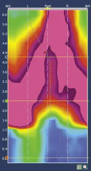 Figure 8b. Reconstruction en 2D du sphincter anal en contraction : image en « Lambda »