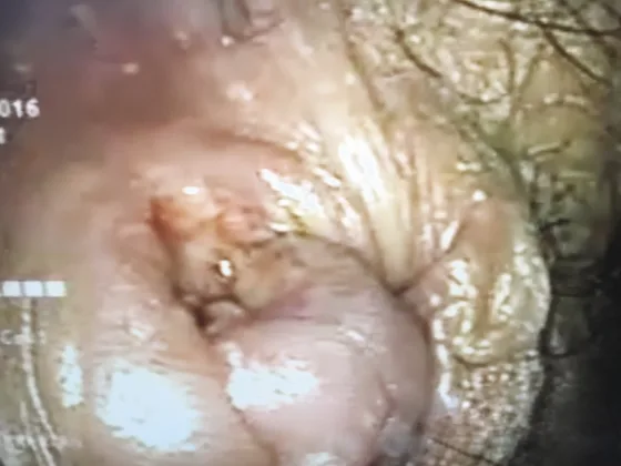 Figure 1. AIN 3 : lésion plane jaune moutarde, anuscopie haute définition