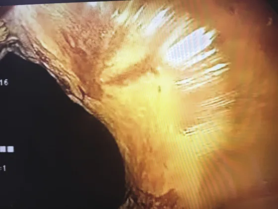 Figure 2. Condolylome acuminé AIN2 : répartition hétérogène du colorant, anuscopie haute définition