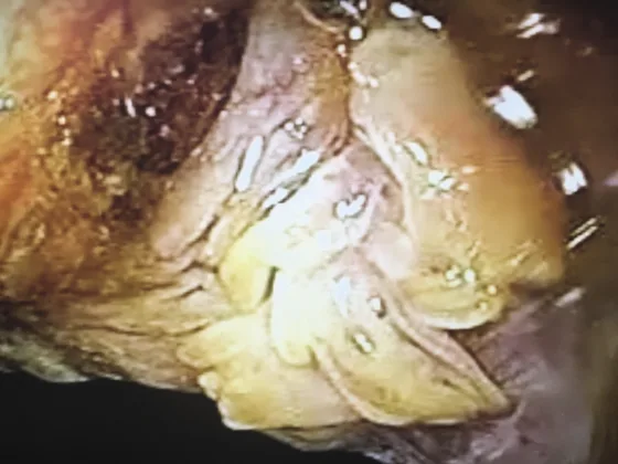 Figure 3. Condolyme acuminé AIN2 : réparation hétérogène du colorant, anuscopie haute définition