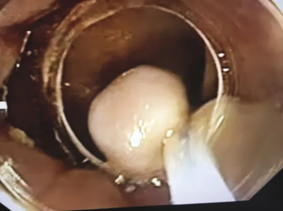 Figure 4. Papille hypertrophique post crise d’hémorroïde