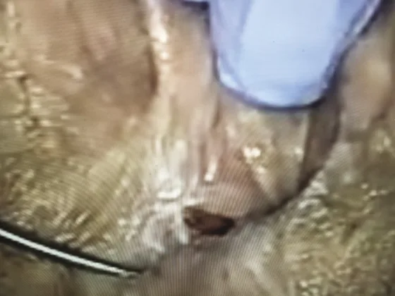 Figure 6. Fissure anale jeune