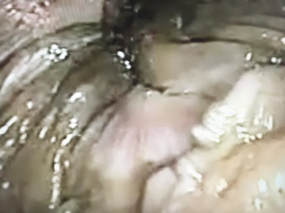 Figure 7. Fissure anale cicatrisée