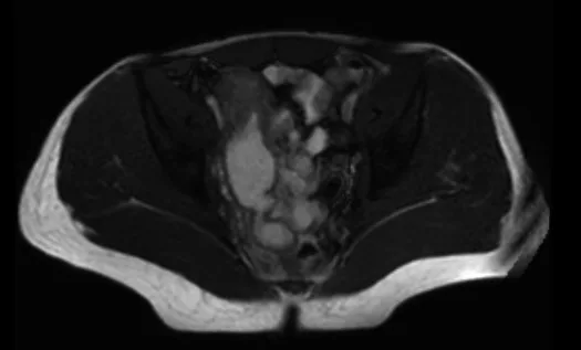 Figure 1. Maladie de Crohn iléale courte, sténosante. Séquences pondérées en T2 d’enteroIRM