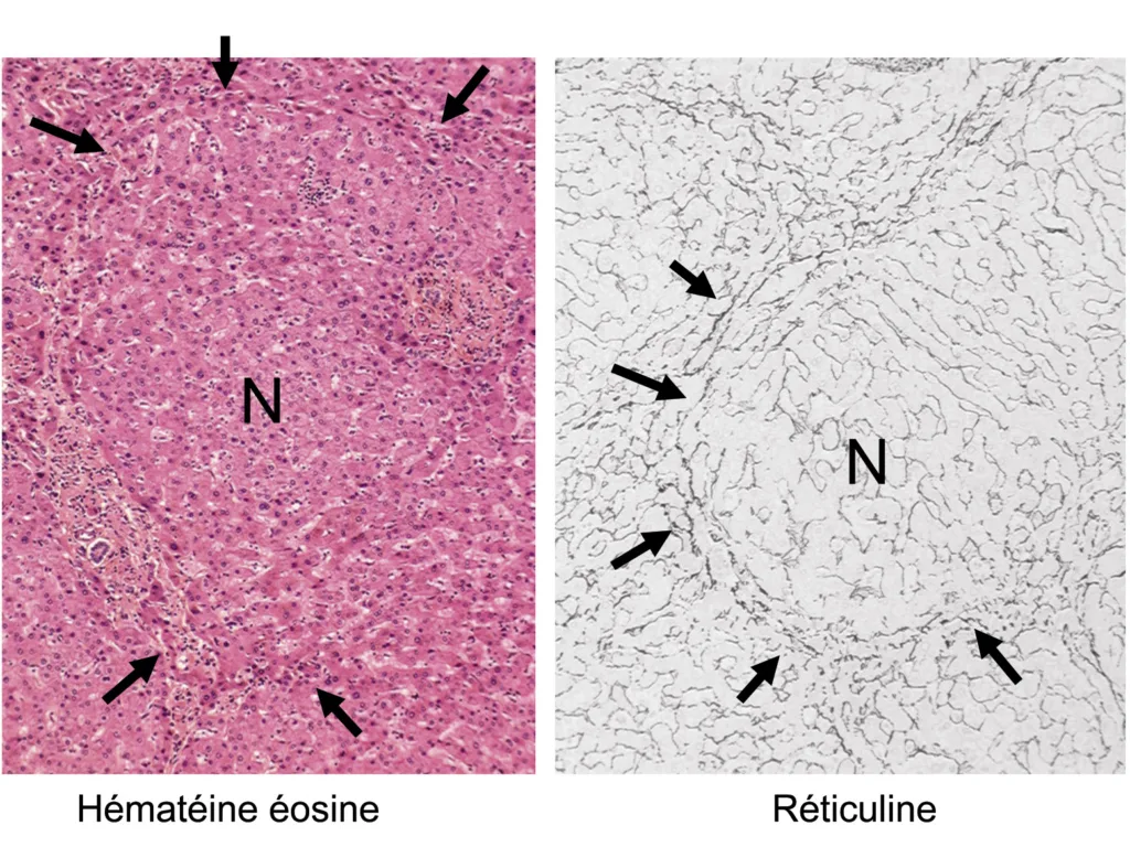 Figure 1. Lésions histologiques d’hyperplasie nodulaire régénérative