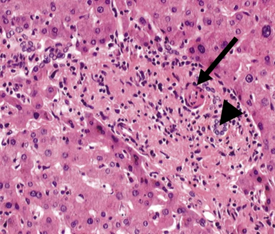 Figure 2. Lésions histologiques de veinopathie portale oblitérante