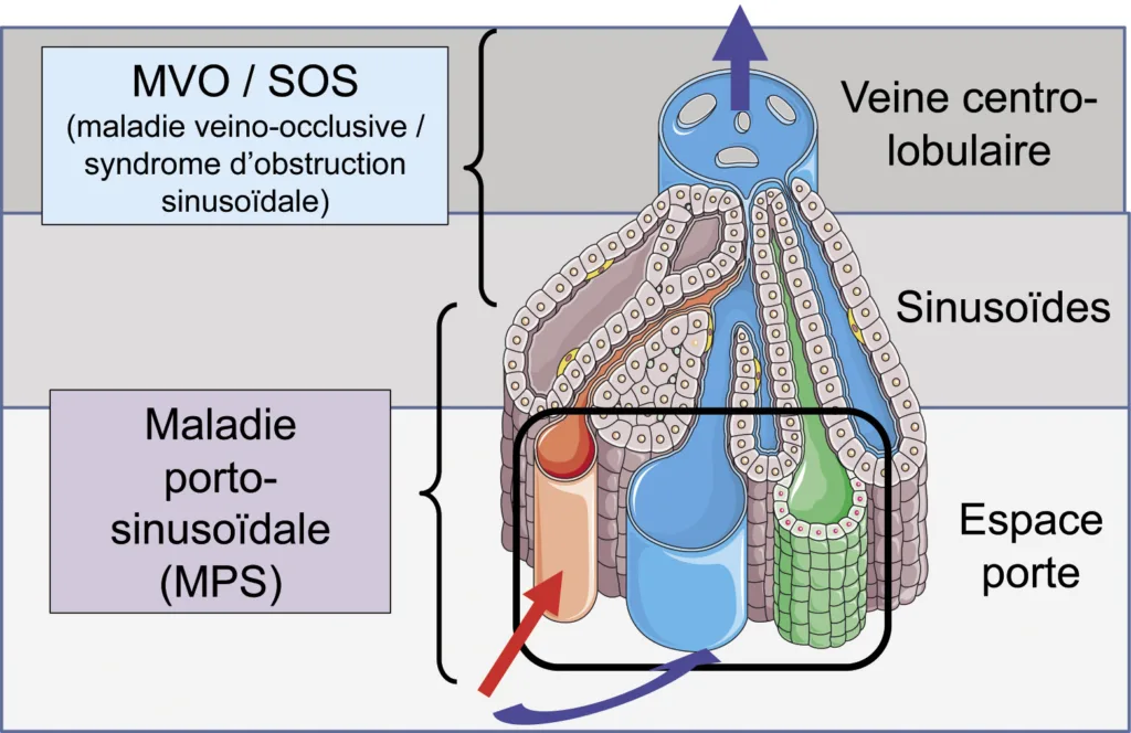Figure 3. Schéma indiquant la localisation primitive des maladies des petits vaisseaux du foie