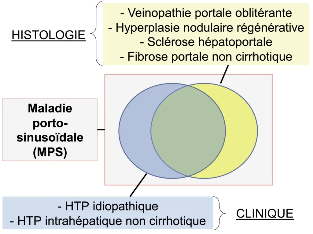 Figure 5. Différentes entités cliniques et histologiques proches de l’hyperplasie nodulaire régénérative. Abréviation : HTP, hypertension portale
