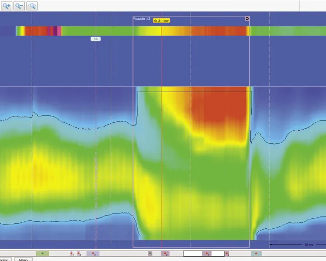 Figure 10. Lors de la manoeuvre de poussée volontaire : bande de pression positive à la partie proximale du canal anal compatible avec un prolapsus rectal intra-anal