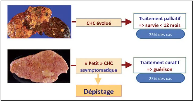 Figure 5. Bases rationnelles du dépistage du CHC
