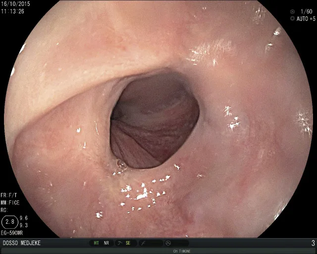 Figure 1. Anneau de Schatzki