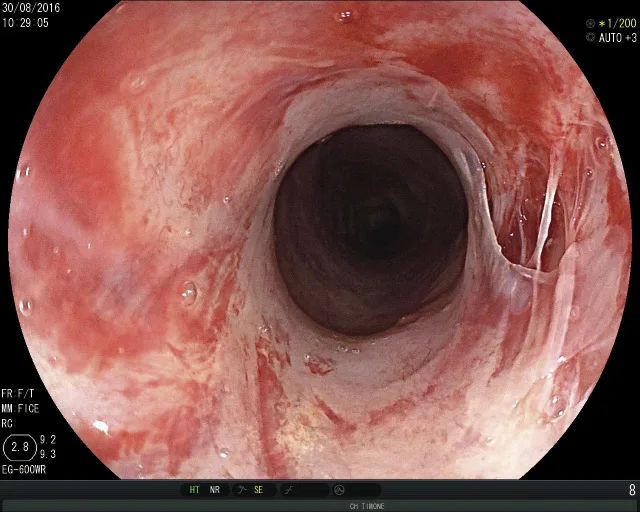 Aspect de la sténose après dilatation avec dilacération muqueuse sans perforation (2B)