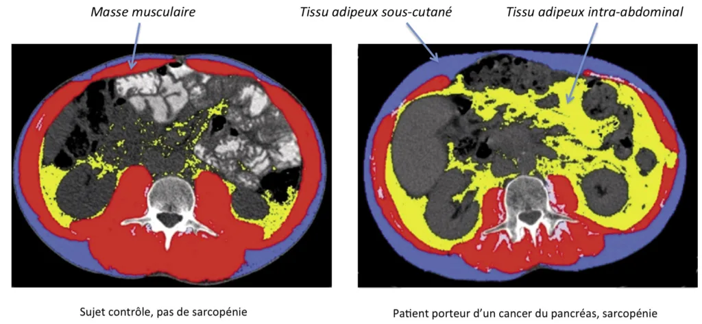 Figure 1. Coupe scannographique passant par L3 d’un sujet contrôle et d’un patient porteur d’un cancer du pancréas avec une sarcopénie