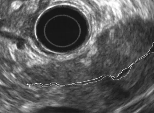 Figure 11. Aspect échoendoscopique caractéristique d’une PAI. Noter la tuméfaction de la région corporéo-caudale et les sténoses multiples du CPP, qui sont superposables à l’aspect macroscopique de la figure 4
