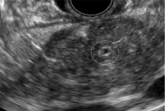 Figure 12. Aspect échoendoscopique de la PAI de type I. Noter l’épaississement hyperéchogène concentrique du CPP au centre de l’hypertrophie hétérogène de la glande