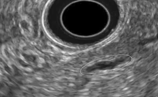Figure 13. Aspect échoendoscopique de la PAI de type II. Noter l’épaississement hypoéchogène de la paroi du CPP responsable d’un aspect filiforme de la lumière du CPP