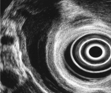 Figure 14. Aspect échoendoscopique de la cholangite sclérosante à IgG4. Noter l’épaississement régulier de 3 mm de la paroi de la VBP en zone sus sténotique, à limite externe nette, fait de 2 liserés hyperéchogènes encadrant un épaississement hypoéchogène dénommé « sandwich pattern »