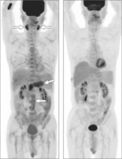 Figure 15. Aspect PET-FDG caractéristique de PAI à IgG4. Noter la fixation des 2 glandes salivaires (Sd de Mikulicz), la fixation péri-aortique abdominale témoignant de la fibrose rétropéritonéale et la fixation diffuse de la glande pancréatique