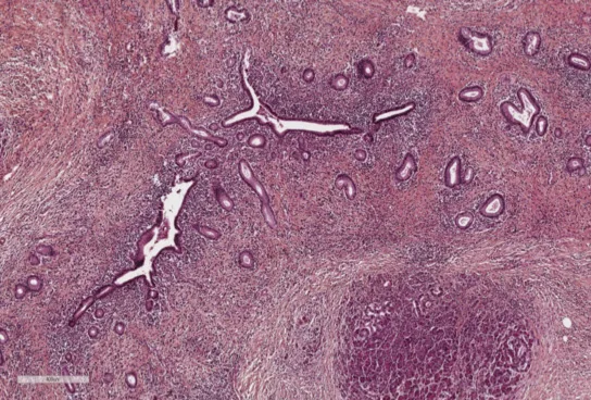 Figure 1. LPSP sur une pancréatectomie. Infiltration lymphoplasmocytaire péri-canalaire, fibrose storiform et phlébite oblitérante