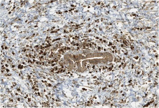 Figure 2. LPSP : Intense marquage des plasmocytes IgG4+ en position péri-canalaire
