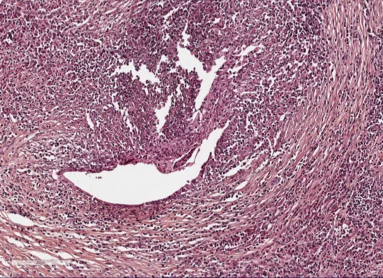 Figure 3. IDCP sur une pièce de pancréatectomie pour adénocarcinome développé sur PAI de type II associée à une RCH ancienne. Infiltration à polynucléaires neutrophiles réalisant une GEL qui détruit et ulcère un canal interlobulaire