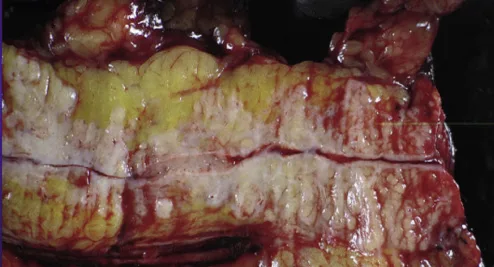 Figure 4. Aspect macroscopique d’une pancréatectomie gauche effectuée à tort pour une PAI de type I. Noter l’importance de la tuméfaction de la glande et les multiples sténoses du CPP au centre de la pièce opératoire