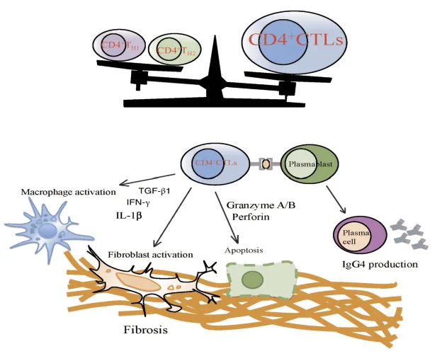 Figure 5. Schéma simplifié de la physiopathogénie de la PAI de type I. Noter que la cellule au centre du processus inflammatoire et fibrosant est ce nouveau lymphocyte T cytotoxique CD4+, qui agit par l’intermédiaire des secrétions de Granzyme A et B, de perforin et d’interferon gamma, de TGF– béta1 et d’interleukine 1béta ainsi que de l’activation du système macrophagique. Ce lymphocyte T cytotoxique est activé par des plasmablastes qui sont à l’origine de la production de plasmocytes IgG4+ qui n’ont quant à eux aucun rôle pathogène