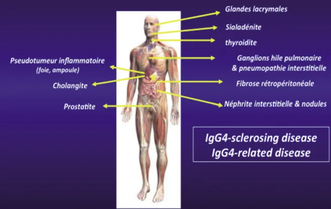 Figure 6. Rappel des principales localisations de la maladie à IgG4 qui peuvent être associées à la PAI de type I