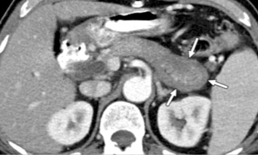 Figure 8. Aspect de la PAI en TDM : Pancréas saucisse et anneau hypodense périphérique (flèches blanches) Cet aspect est un critère d’imagerie parenchymateuse typique de niveau 1 dans la classification ICDC. On le qualifie de critère 1P
