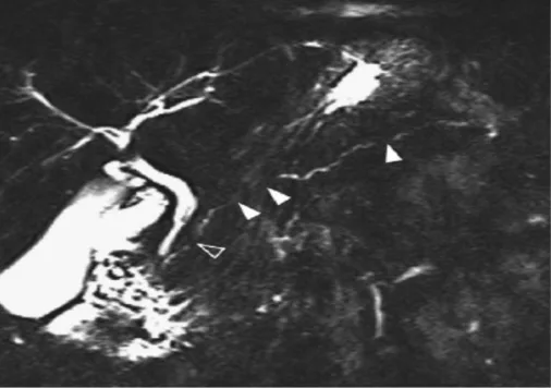 Figure 9. Aspect canalaire typique d’une PAI de type II sur une CP-IRM parfaitement techniquée. Critère 1D de la classification ICDC