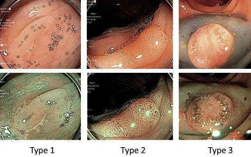 Figure 1. Classification de NICE pour les polypes coliques avec l’utilisation du NBI sans grossissement optique. Type 1 (polype hyperplasique) : couleur clair, absence de vaisseau, surface blanche homogène ; type 2 (polype adénomateux) : couleur plus brune que la muqueuse, vaisseaux encerclant des structures blanchâtres, surface avec des structures blanches ovalaires ou branchées ; type 3 (cancer) : couleur brune ou noire, vaisseaux irréguliers qui disparaissent au centre de la lésion, surface irrégulière