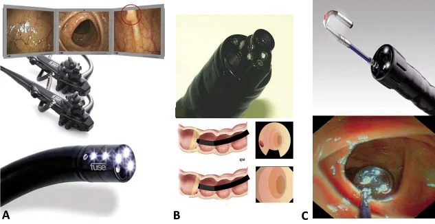 Figure 2. Endoscopes à vision élargie pour améliorer l’analyse de la muqueuse colorectale. A : système « Full-Spectrum Endoscopy® » ou FUSE®, B : coloscope « Extra-Wide-Angle-View® » et C : le troisième oeil ou « Third Eye Retroscope® »