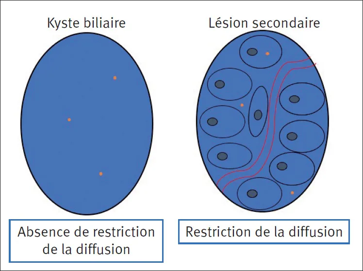 Figure 1. Illustration schématique de la restriction de la diffusion observée dans une lésion secondaire (schéma de droite) par opposition à la diffusion observée dans un kyste simple. Les protons (oranges) ont une liberté de déplacement réduite dans les lésions néoplasiques du fait d’une augmentation de la cellularité, d’une augmentation de la pression capillaire et d’une modification de l’interstitium tumoral.