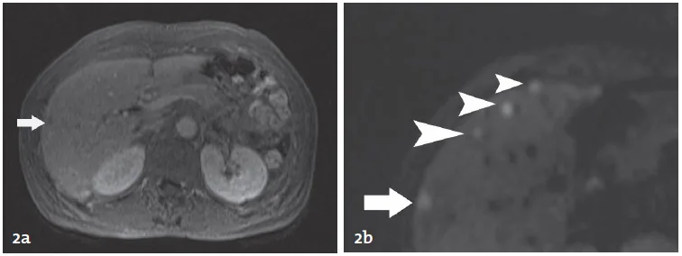 Figure 2. Performances de la séquence de diffusion pour la détection des lésions secondaires. Après injection de chélates de gadolinium, une seule lésion de 8 mm du segment 5 est visible en phase portale (flèche figure 2a). Sur la séquence de diffusion (Pondération diffusion b = 800 sec/mm2), plusieurs lésions secondaires additionnelles sont nettement identifiables (têtes de flèche figure 2b) en plus de la lésion du segment 5 (flèche figure 2b).