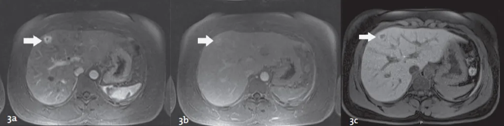 Figure 4. Optimisation de la caractérisation d’une Hyperplasie Nodulaire Focale après injection de produit de contraste hépatospécifique. Exploration IRM chez une patiente de 36 ans avec découverte fortuite d’un nodule de 14 mm iso-échogène du foie droit. Après injection, il existe un rehaussement artériel homogène de la lésion (Flèche Figure 4a) sans rehaussement évident de la zone stellaire en phase portale ou d’équilibre (Flèche Figure 4b). En phase hépatobiliaire, acquise 1 h après l’injection de Gd-BOPTA (Figure 4c), le nodule présente un rehaussement en couronne caractéristique des nodules d’HNF, permettant d’éviter une surveillance rapprochée ou une biopsie dirigée.