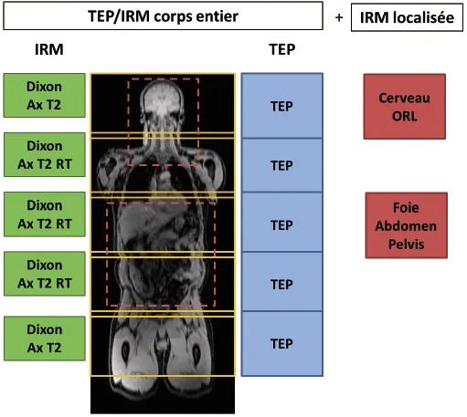 Figure 1. Proposition d’un protocole standard de bilan oncologique en TEP/IRM. L’examen corps entier est complété par une ou plusieurs acquisitions IRM plus localisées. Dixon : séquence IRM réalisée pour la génération une carte d’atténuation. Ax T2 RT : coupes axiales en pondération T2 avec synchronisation respiratoire