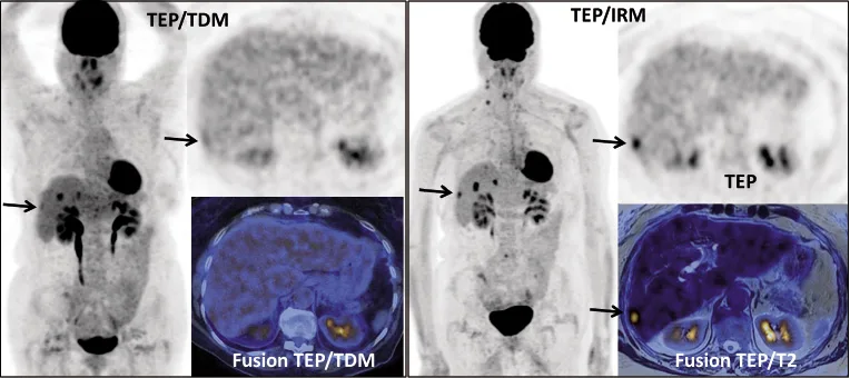 Figure 3a. Femme de 75 ans. Cancer colorectal (T3N1M0) traité par chirurgie et chimiothérapie. Bilan de récidive hépatique. Réalisation d’un TEP/TDM suivi d’un TEP/IRM. Le TEP/TDM montre plusieurs fixations hépatiques. Le TEP/IRM permet de préciser l’étendue de l’atteinte hépatique, en montrant clairement une lésion sous capsulaire du secteur postérieur du foie droit, très mal visualisée sur le TEP/TDM (flèche)