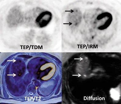Figure 3b. Même patiente. Coupes transversales au niveau du dôme hépatique. Le TEP/TDM apparaît normal à ce niveau. Le TEP/IRM montre deux fixations focales de petite taille, dont le caractère pathologique est difficile à affirmer. Une séquence de diffusion montre clairement deux hypersignaux pathologiques en regard des deux hyperfixations. La confrontation du TEP et de la diffusion permet de renforcer la confiance dans le diagnostic de métastases hépatiques à ce niveau