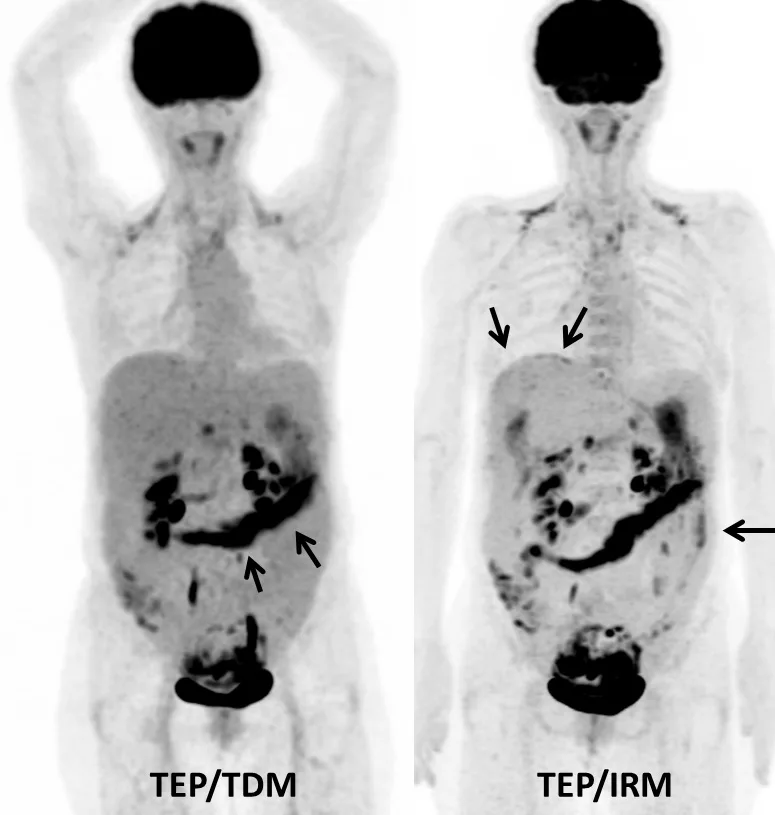 Figure 4a. Femme de 62 ans. Bilan d’extension initial d’un carcinome séreux de l’ovaire. Le TEP/TDM montre des fixations en rapport avec une carcinose péritonéale pelvienne et du grand épiploon (flèches). Le TEP/IRM réalisé juste après le TEP/TDM montre des sites supplémentaires d’atteinte péritonéale, dans la région péri-hépatique et la gouttière pariéto-colique gauche (flèches)