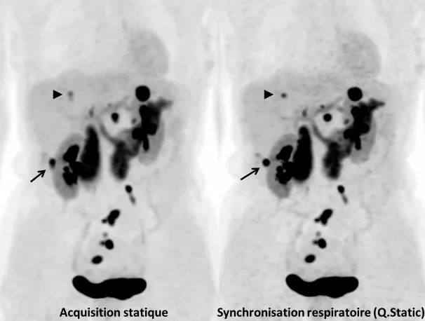 Figure 5. Tumeur neuro-endocrine différenciée du grêle. Bilan de réévaluation par TEP/IRM à la Fluoro-DOPA. Comparaison des acquisitions sans et avec synchronisation respiratoire. L’examen montre des lésions tumorales ganglionnaires pelviennes, ainsi que plusieurs lésions hépatiques. La lésion hépatique indiquée par une flèche apparaît plus nette sur l’image synchronisée, avec moins de flou. La lésion indiquée par une tête de flèche, nettement visible sur l’image synchronisée, apparaît presque comme deux lésions contiguës sur l’image non synchronisée. La synchronisation respiratoire a pour avantages de diminuer le flou dans les images, d’améliorer le recalage avec l’IRM, et d’améliorer la quantification de la fixation par le SUV