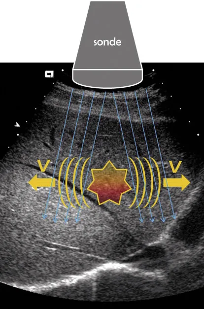 Figure 1. Principe de mesure de l’élasticité hépatique par les techniques ARFFI et SSI. Une onde de compression créait une onde de cisaillement. L’onde de cisaillement se propage perpendiculairement à l’onde de compression. La vitesse de propagation est mesurée par des tirs ultrasonores. La vitesse de propagation de l’onde de cisaillement est proportionnelle à la dureté (l’élasticité) hépatique. 
