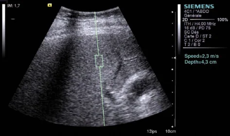 Figure 2. Écran de mesure de la dureté hépatique avec la technique ARFI. La mesure est ponctuelle. La fenêtre de mesure a une taille de 5 x 10 mm. La valeur est donnée en m/s (dans les prochain mois elle sera aussi donnée en KPa).